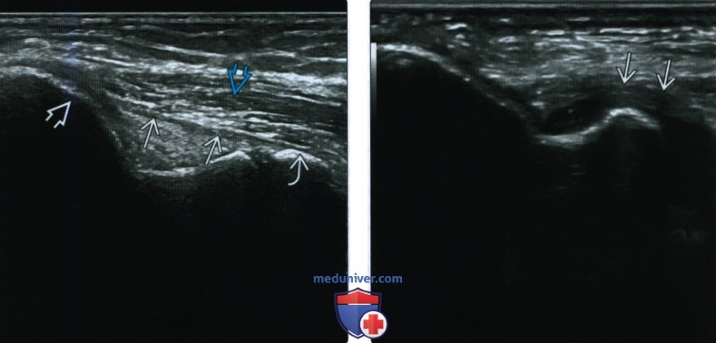 Рентгенограмма, МРТ, УЗИ при повреждении локтевого сустава по типу вальгусной нагрузки