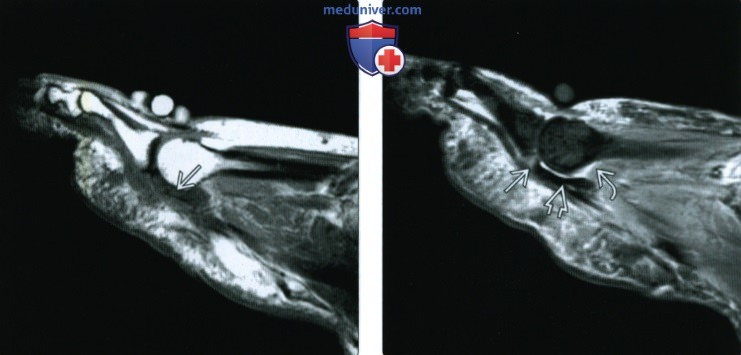 Рентгенограмма, МРТ, УЗИ при повреждении связок 2-5 плюснефаланговых суставов стопы