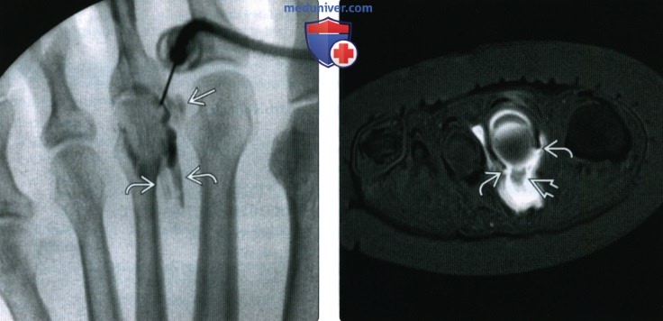 Рентгенограмма, МРТ, УЗИ при повреждении связок 2-5 плюснефаланговых суставов стопы