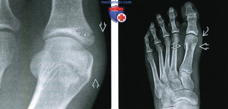 Рентгенограмма, МРТ, УЗИ при повреждении связок первого плюснефалангового сустава стопы
