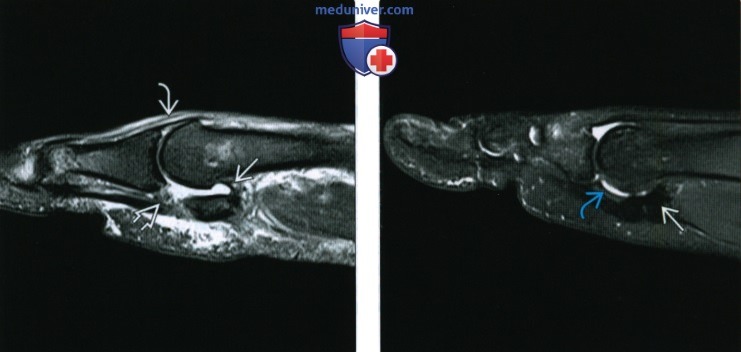 Рентгенограмма, МРТ, УЗИ при повреждении связок первого плюснефалангового сустава стопы