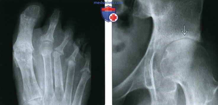 Рентгенограмма, МРТ, УЗИ при псориатическом артрите