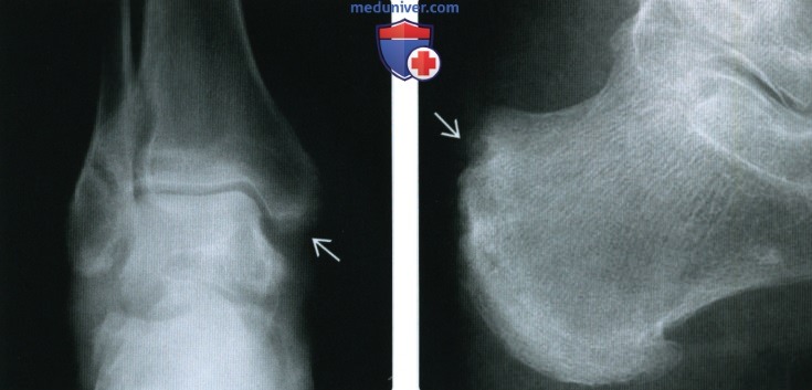 Рентгенограмма, МРТ, УЗИ при псориатическом артрите