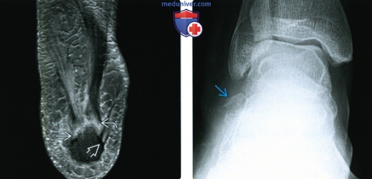Рентгенограмма, МРТ, УЗИ при разрыве мышц стопы и подошвенной фасции