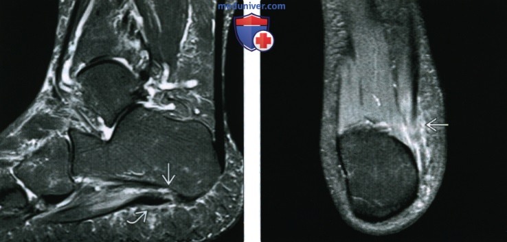 Рентгенограмма, МРТ, УЗИ при разрыве мышц стопы и подошвенной фасции