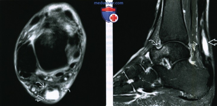 Рентгенограмма, МРТ, УЗИ при разрыве и тендинопатии ахиллова сухожилия