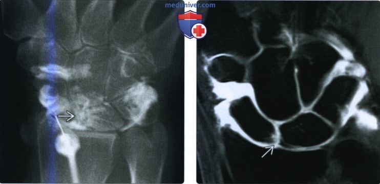 Рентгенограмма, МРТ, УЗИ при разрыве внутренней связки кисти