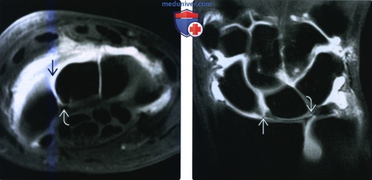 Рентгенограмма, МРТ, УЗИ при разрыве внутренней связки кисти