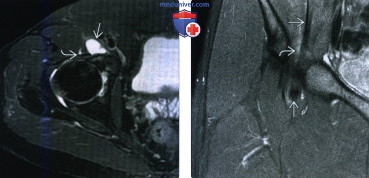 Рентгенограмма, МРТ, УЗИ при синдроме щелкающего бедра