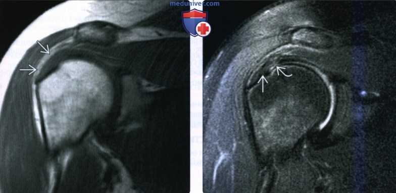 Рентгенограмма, МРТ, УЗИ при тендинопатии ротаторной манжеты