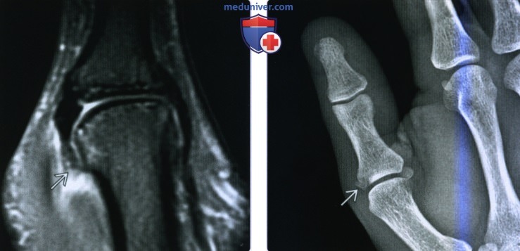 Рентгенограмма, МРТ, УЗИ при травме коллатеральной связки пальцев кисти