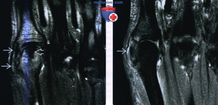 Рентгенограмма, МРТ, УЗИ при травме коллатеральной связки пальцев кисти