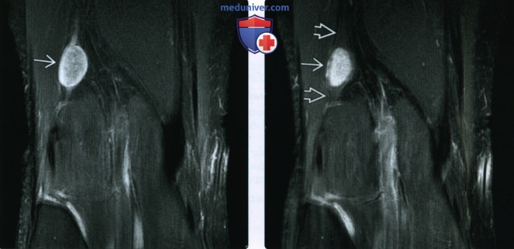 Рентгенограмма, МРТ, УЗИ при травме малоберцового нерва