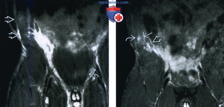 Рентгенограмма, МРТ, УЗИ при травме мышц живота