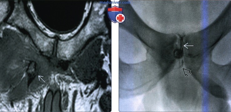 Рентгенограмма, МРТ, УЗИ при травме приводящих мышц бедра