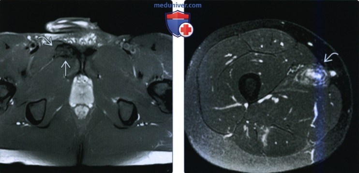 Рентгенограмма, МРТ, УЗИ при травме приводящих мышц бедра