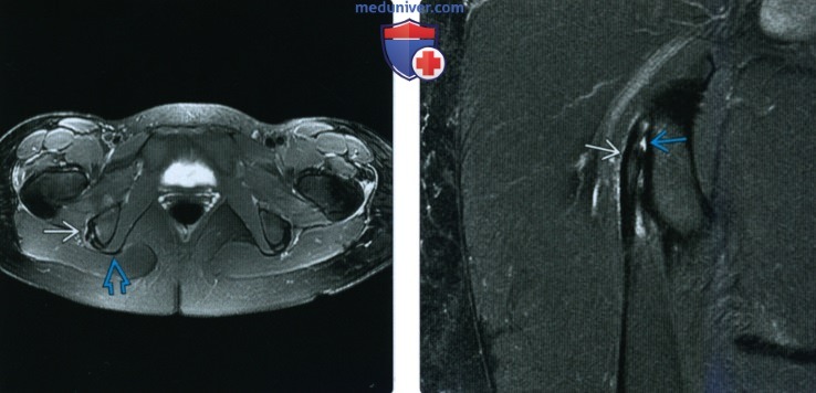 Рентгенограмма, МРТ, УЗИ при травме проксимального отдела мышц задней поверхности бедра