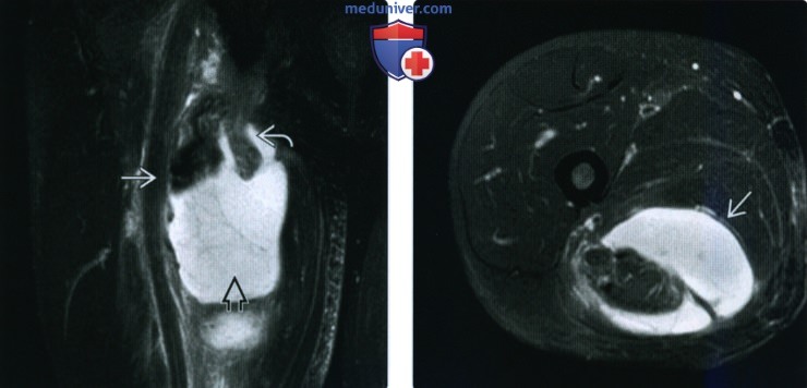 Рентгенограмма, МРТ, УЗИ при травме проксимального отдела мышц задней поверхности бедра