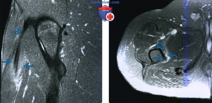 Рентгенограмма, МРТ, УЗИ при травме сгибателей бедра