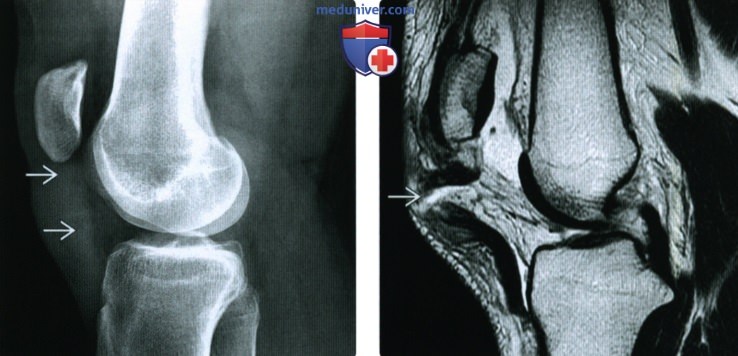 Рентгенограмма, МРТ, УЗИ при травме сухожилия надколенника