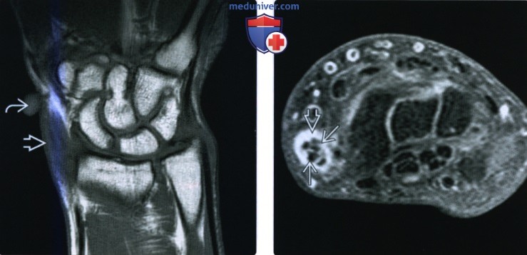 Рентгенограмма, МРТ, УЗИ при травме сухожилия разгибателя кисти и пальцев