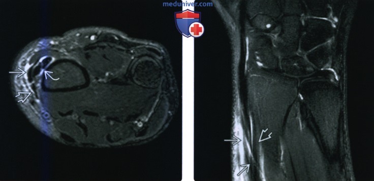 Рентгенограмма, МРТ, УЗИ при травме сухожилия разгибателя кисти и пальцев