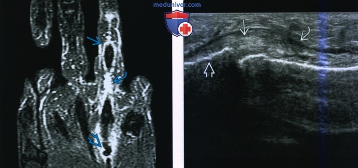 Рентгенограмма, МРТ, УЗИ при травме сухожилия сгибателя кисти и пальцев