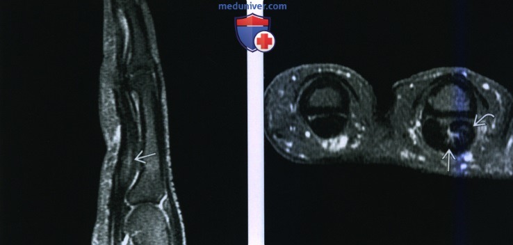 Рентгенограмма, МРТ, УЗИ при травме сухожилия сгибателя кисти и пальцев