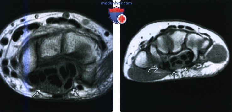 Рентгенограмма, МРТ, УЗИ при туннельном синдроме запястья