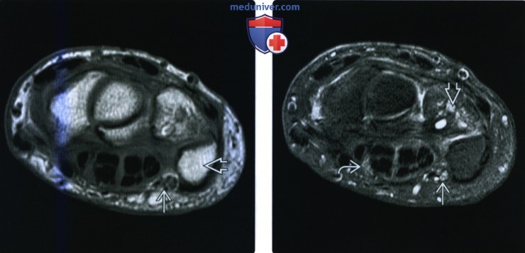 Рентгенограмма, МРТ, УЗИ при туннельном синдроме запястья