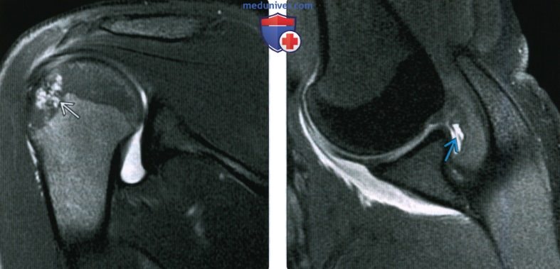 Рентгенограмма, МРТ при внутреннем импиджменте плечевого сустава
