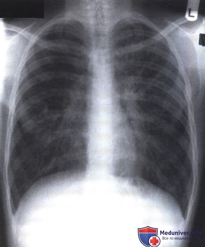 Рентгенограмма с участками затемнения в обоих легких при муковисцидозе