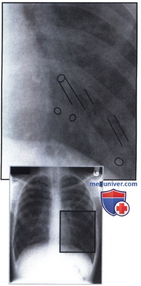 Рентгенограмма с участками затемнения в обоих легких при муковисцидозе