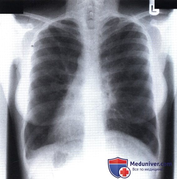 Рентгеновский снимок с необычной тенью средостения при синдроме Картагенера
