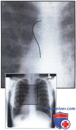 Рентгеновский снимок с необычной тенью средостения при синдроме Картагенера