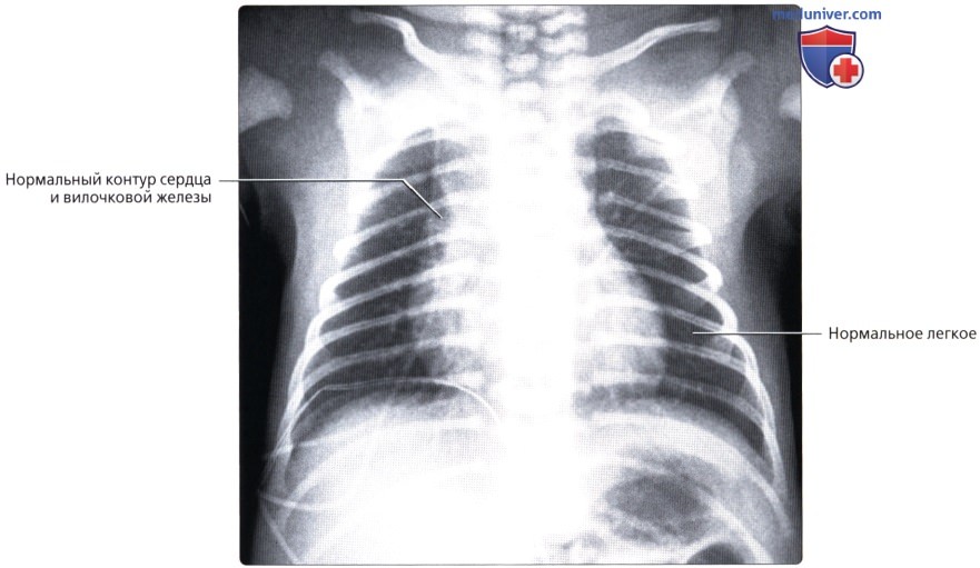 Рентгенограмма грудной клетки новорожденного