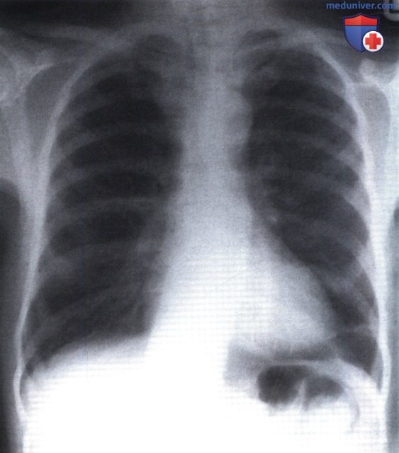 Рентгенограмма с легкими и средостением без патологии при метастазах в кости