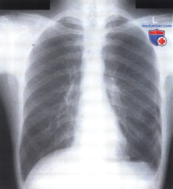 Рентгенограмма с участком просветления в левом легком при ограниченном пневмотораксе