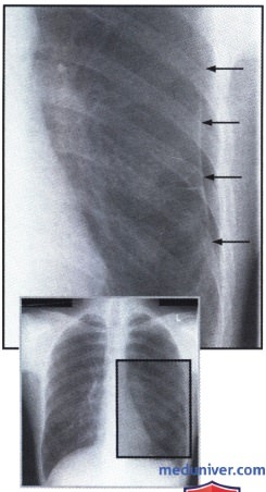 Рентгенограмма с участком просветления в левом легком при ограниченном пневмотораксе