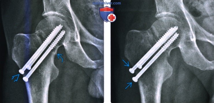 Рентгенограмма после операции по поводу травмы таза, тазобедренного сустава, бедра