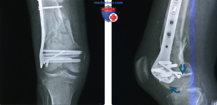 Рентгенограмма после операции по поводу травмы таза, тазобедренного сустава, бедра