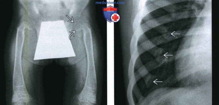 Рентгенограмма при остеомаляции и рахите