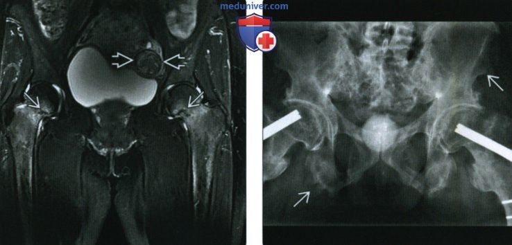 Рентгенограмма при остеомаляции и рахите