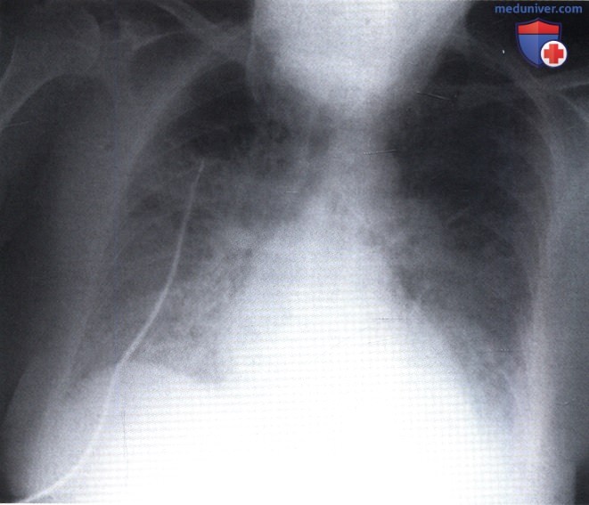 Рентгенограмма с затемнением в обоих легочных полях при остром отеке легких