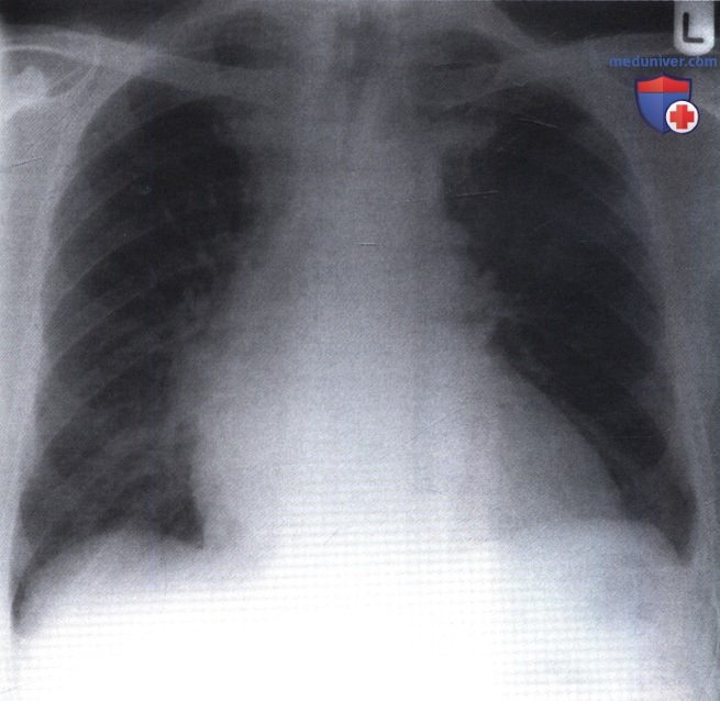 Рентгенограмма с патологической формой сердца при пороке