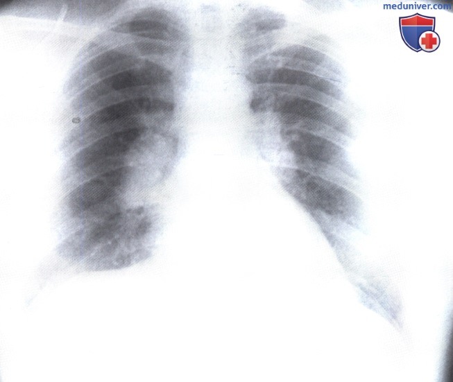 Рентгенограмма с патологическими изменениями корней легких