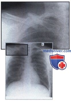 Рентгеновский снимок с переломом правой ключицы