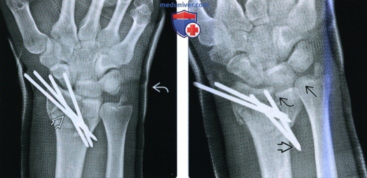 Рентгенограмма при переломе дистального эпиметафиза лучевой кости (переломе луча в типичном месте)