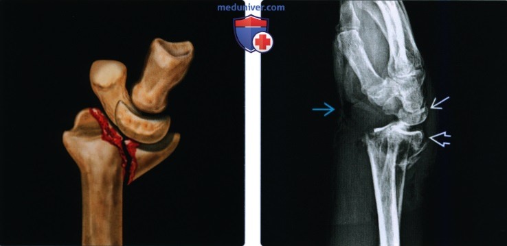 Рентгенограмма при переломе дистального эпиметафиза лучевой кости (переломе луча в типичном месте)