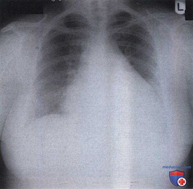 Рентгенограмма с увеличением тени сердца при перикардите